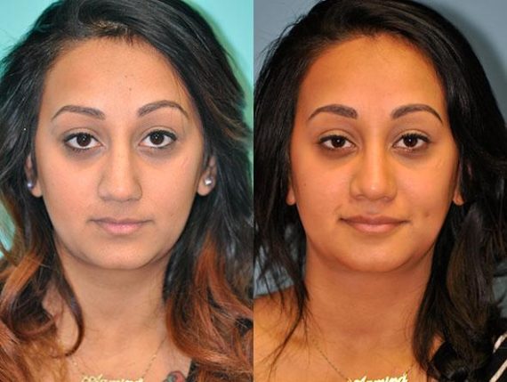 Dr. Naderi Ethnic Rhinoplasty Before and After