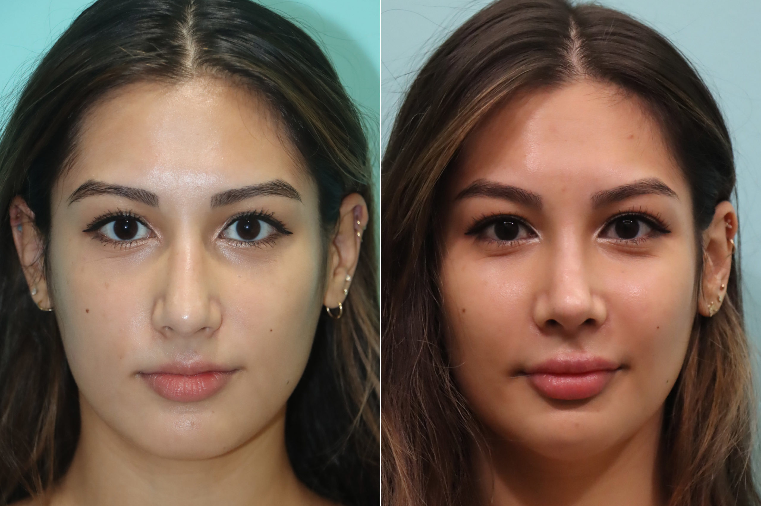 Dr. Naderi Ethnic Rhinoplasty Reviews, Cost, Before and After