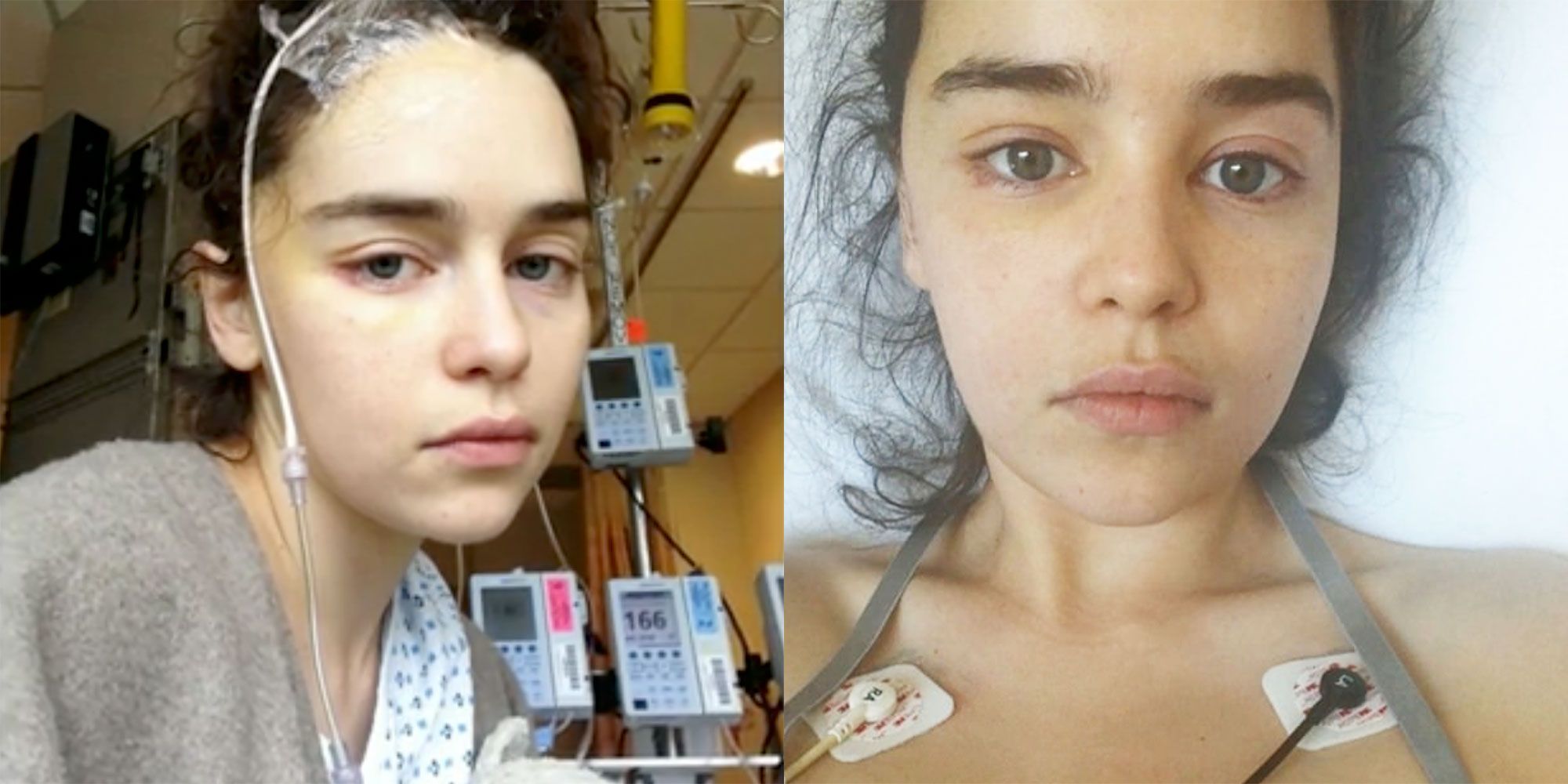 The Game of Thrones star Emilia Clarke revealed her diagnosis of brain aneurysms | Emilia Clarke Brain Condition