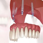 Exploring Different Types of Dental Implants: A Comprehensive Guide