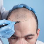 Hair Transplant: A Comprehensive Guide to Understanding the Procedure and Costs
